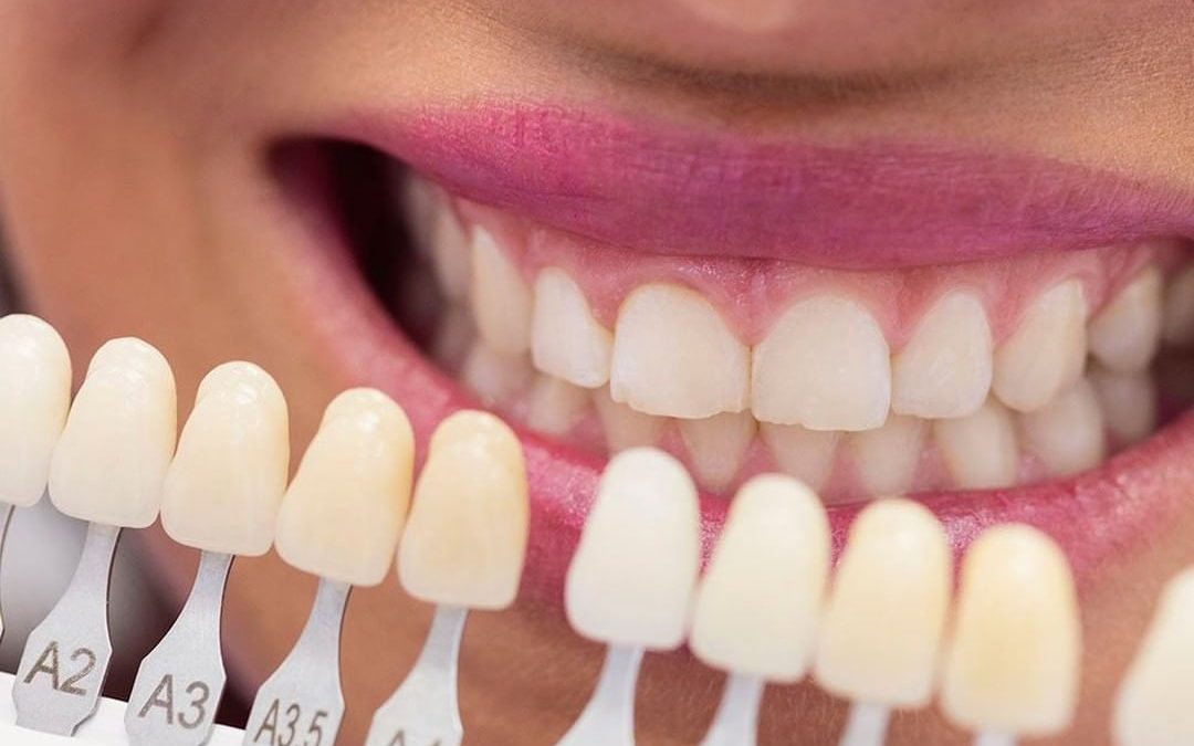 3 cosas que podemos hacer para aumentar la durabilidad del blanqueamiento dental