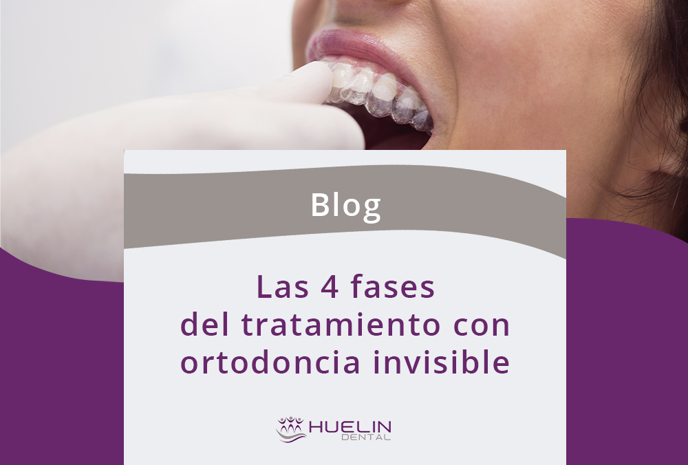 Las 4 fases del tratamiento con ortodoncia invisible