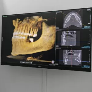 Radiografía TAC 3D