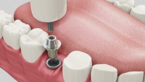 proceso del implante dental