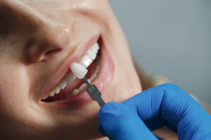 dientes carillas
