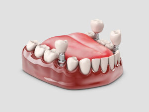 implantes dentales rechazo